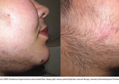 Paradoxical Hypertrichosis after laser